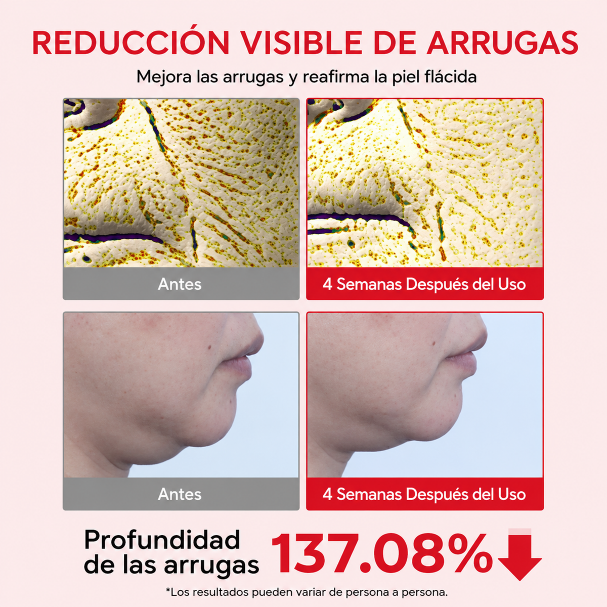 Reducción de arrugas