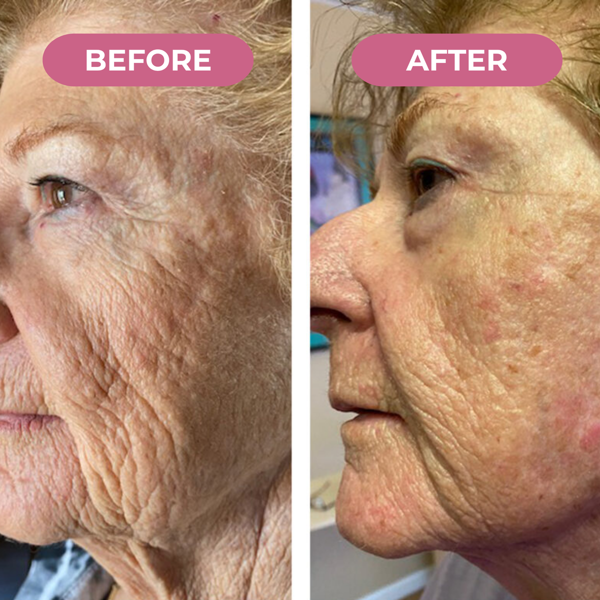 Koriderm™ Mascarilla Nocturna de Colágeno